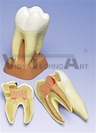 Upper Triple-Root Molar with Caries, 2 part